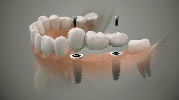 Implantate