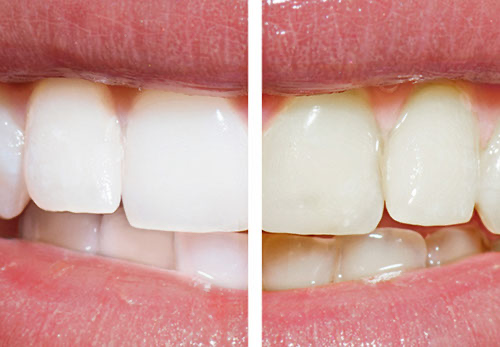 Prophylaxe & Bleaching
